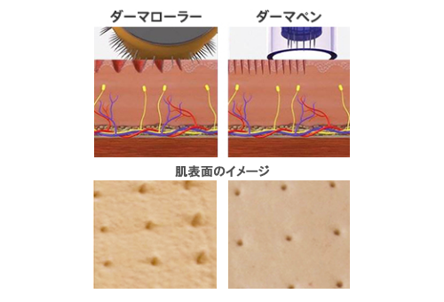 ダーマローラーとダーマペン比較