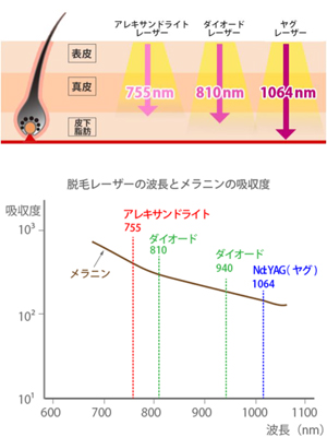 アレキサンドライトレーザーとヤグレーザー