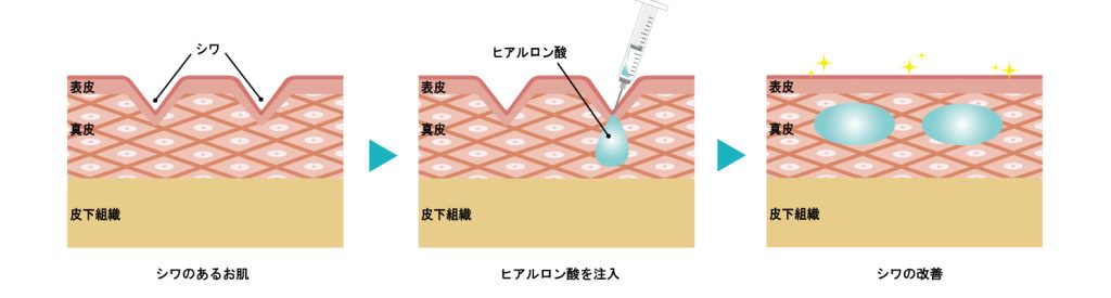 シワが改善するメカニズム