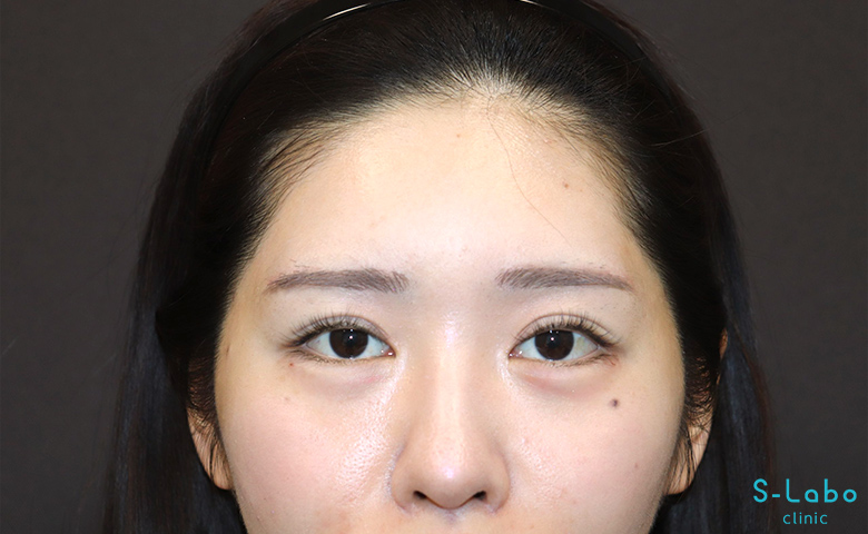 【30代女性・ぷっくり目元で一気にあか抜け】涙袋ヒアルロン酸（注入直後）