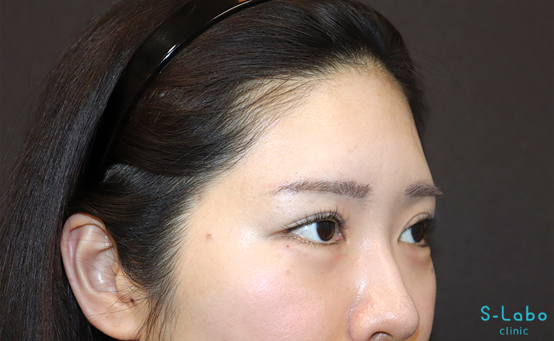 【30代女性・ぷっくり目元で一気にあか抜け】涙袋ヒアルロン酸（注入直後）