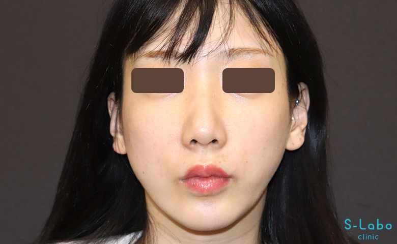 【20代女性・骨格の左右差をヒアルロン酸で補正】頬ヒアルロン酸（2か月後）