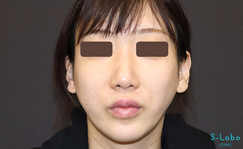 【20代女性・骨格の左右差をヒアルロン酸で補正】頬ヒアルロン酸（2か月後）