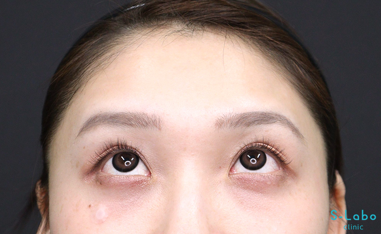 【20代女性・バレずに始めるシワ予防】額ボトックス（3週間後）