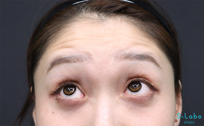 【20代女性・バレずに始めるシワ予防】額ボトックス（3週間後）