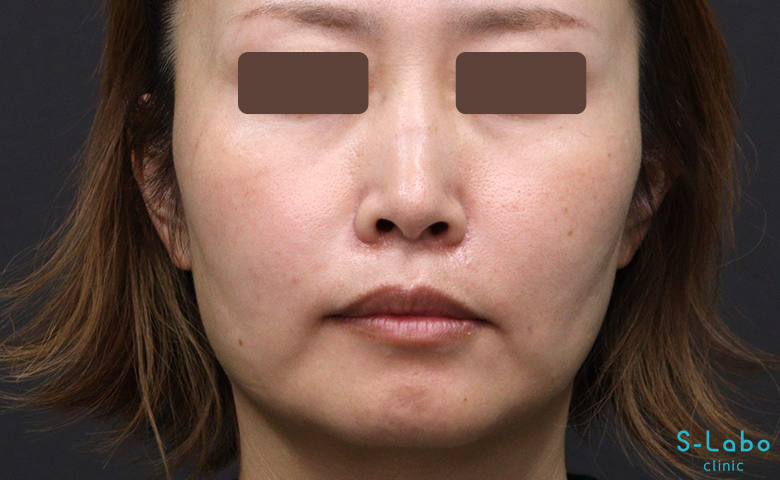 【30代女性・鼻横の溝を自然にアップして若返る】ほうれい線・貴族ヒアルロン酸（2週間後）