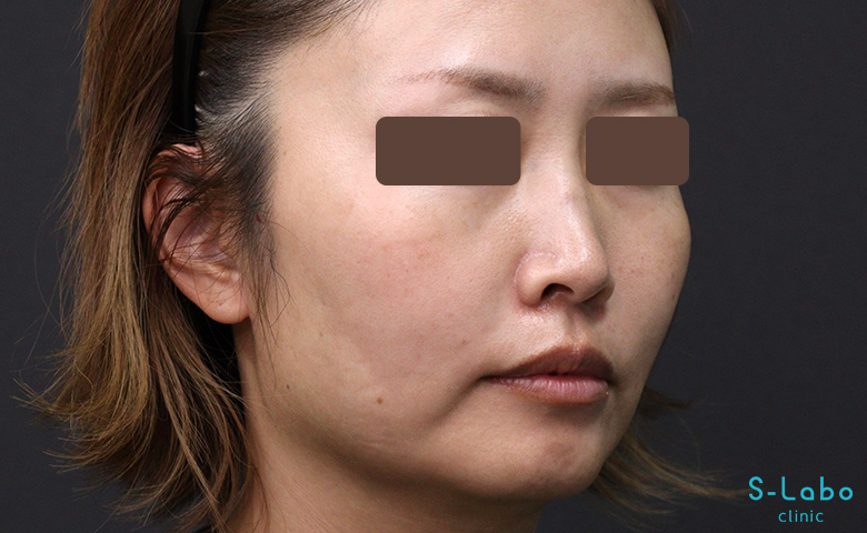 【30代女性・鼻横の溝を自然にアップして若返る】ほうれい線・貴族ヒアルロン酸（2週間後）