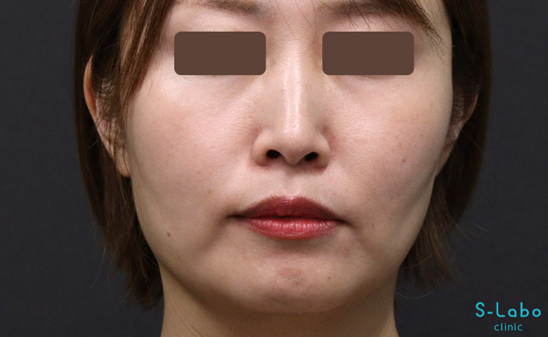【30代女性・鼻横の溝を自然にアップして若返る】ほうれい線・貴族ヒアルロン酸（2週間後）