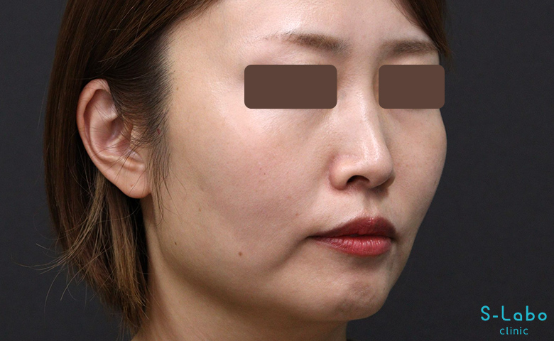 【30代女性・鼻横の溝を自然にアップして若返る】ほうれい線・貴族ヒアルロン酸（2週間後）