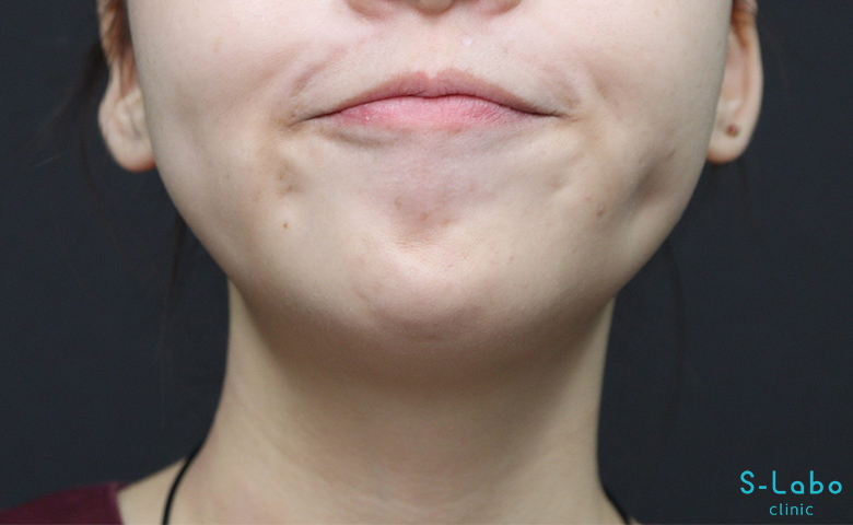 【20代女性・梅干しジワをなくして若々しい口元に】アゴボトックス（3週間）