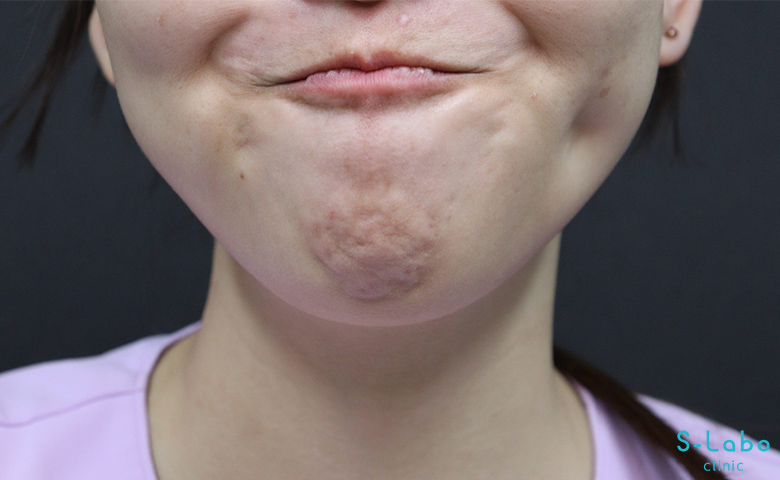 【20代女性・梅干しジワをなくして若々しい口元に】アゴボトックス（3週間）