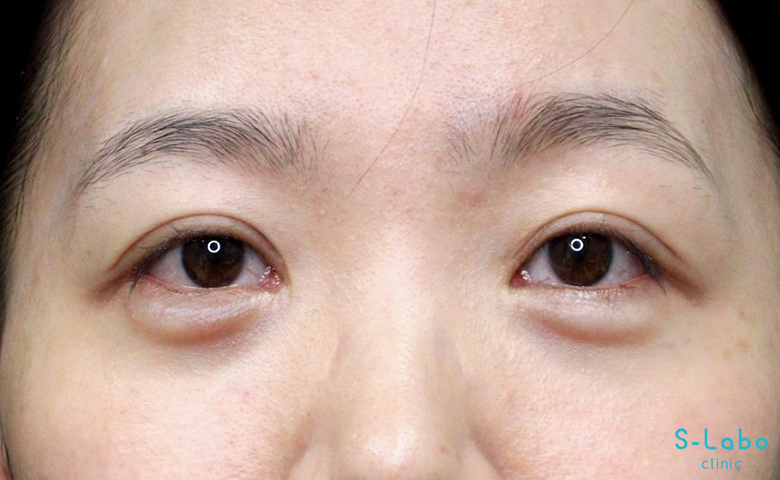 【20代女性・笑った時の涙袋を通常時にも自然に】涙袋ヒアルロン酸（2か月後）