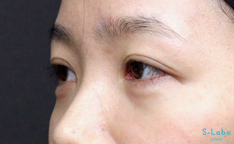 【20代女性・笑った時の涙袋を通常時にも自然に】涙袋ヒアルロン酸（2か月後）