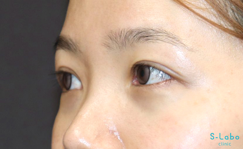 【20代女性・笑った時の涙袋を通常時にも自然に】涙袋ヒアルロン酸（2か月後）