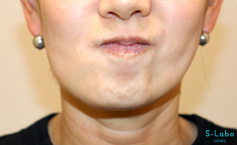 【40代女性・梅干しジワを無くして写真映りをよくしたい】アゴボトックス（3週間）