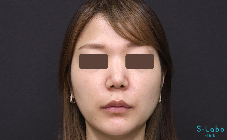【30代女性・鼻横の溝改善で老け顔解消】ほうれい線ヒアルロン酸（注入直後）
