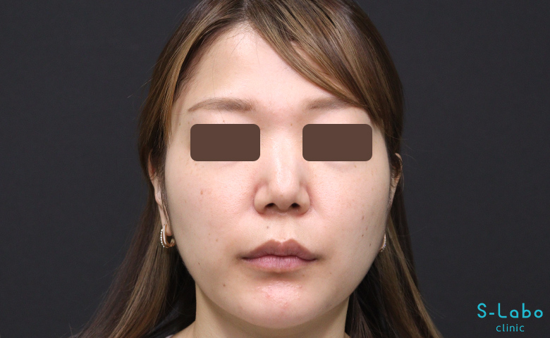 【30代女性・鼻横の溝改善で老け顔解消】ほうれい線ヒアルロン酸（注入直後）