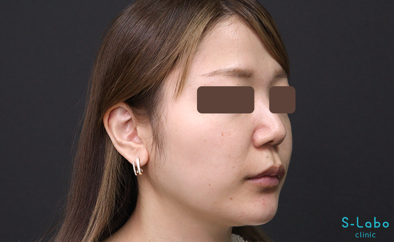 【30代女性・鼻横の溝改善で老け顔解消】ほうれい線ヒアルロン酸（注入直後）