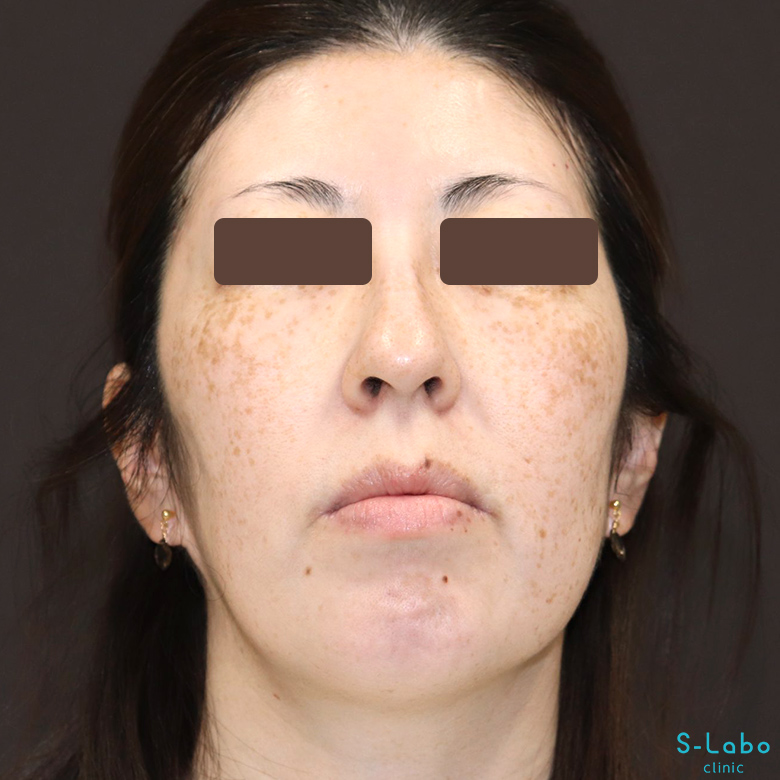 【40代・シミだらけの肌からの卒業】スポット＋トーニング（1年4か月）