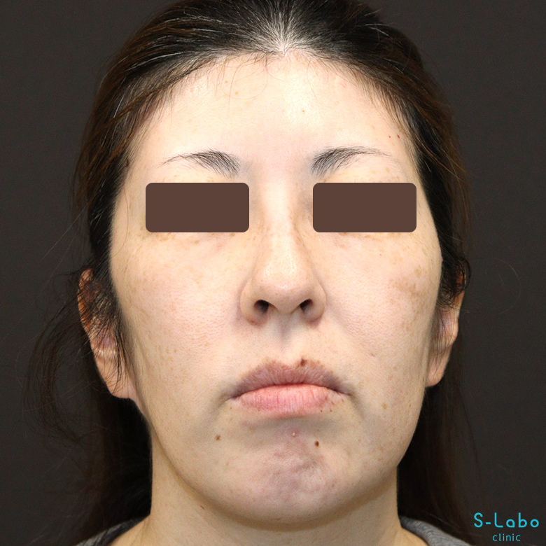 【40代・シミだらけの肌からの卒業】スポット+トーニング(1年4か月)