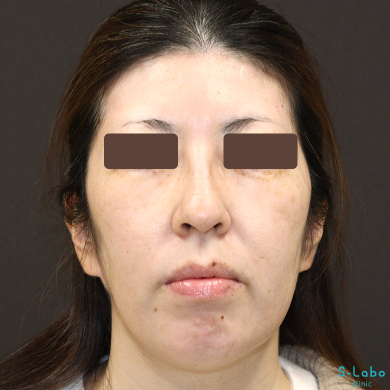 【40代・シミだらけの肌からの卒業】スポット+トーニング(1年4か月)