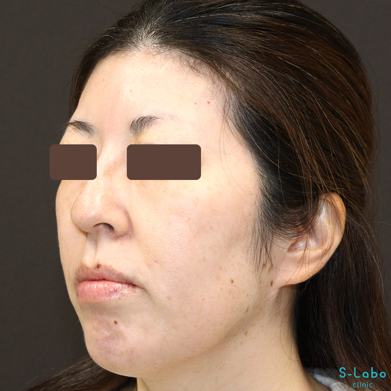 【40代・シミだらけの肌からの卒業】スポット+トーニング(1年4か月)