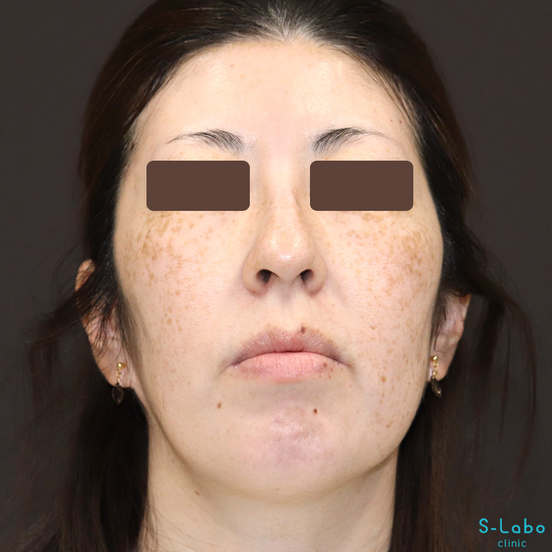 【40代・シミだらけの肌からの卒業】スポット＋トーニング（1年4か月）