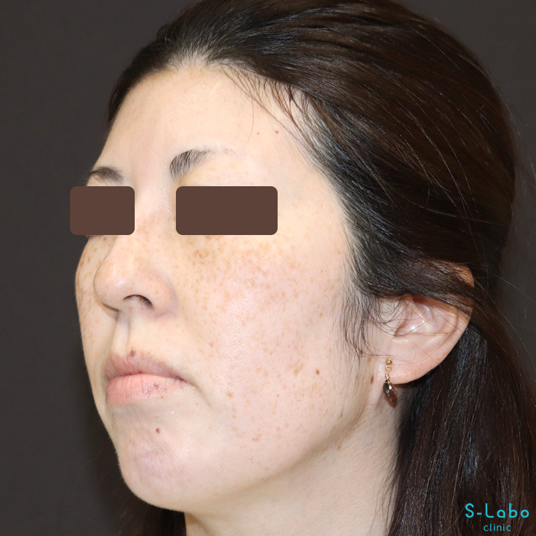 【40代・シミだらけの肌からの卒業】スポット+トーニング(1年4か月)